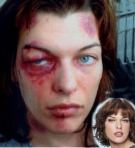 Black eye Black eye